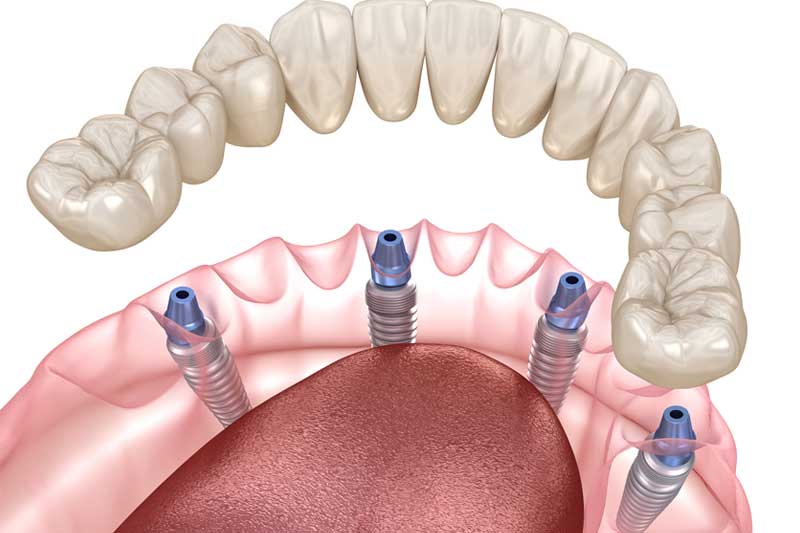 Dental Implant 3D
