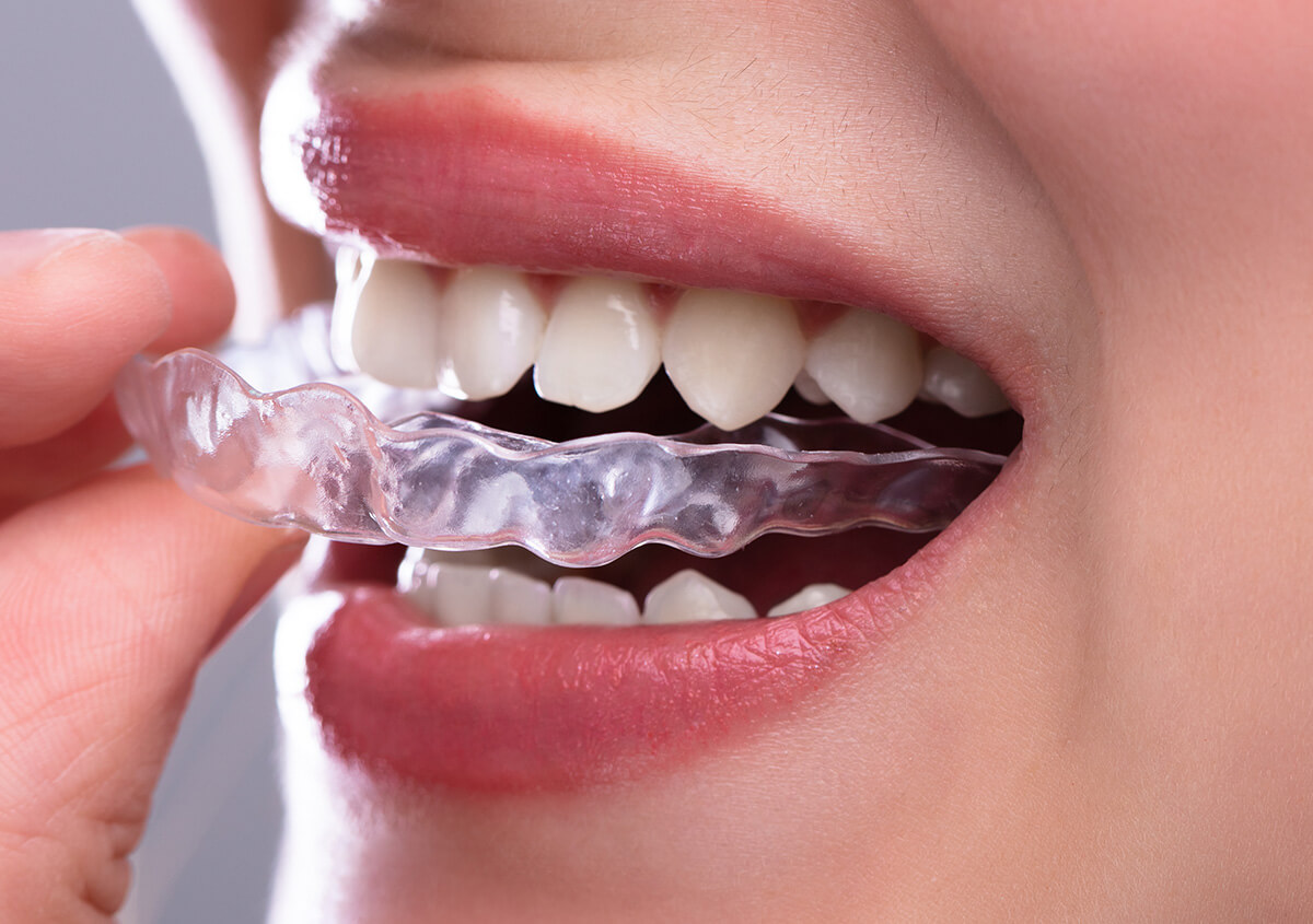 Invisalign Clear Aligners in Pierrefonds QC Area