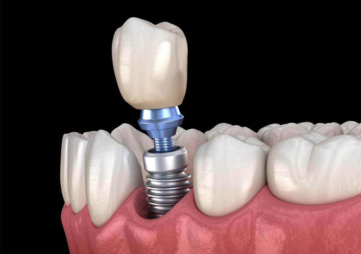 Dental Implants Dentist in Pierrefonds Area